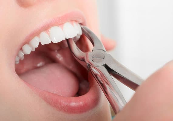 Tooth extraction Dental Implants
