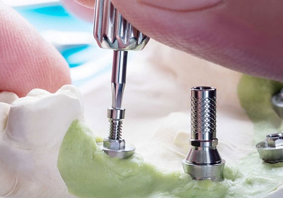 Implant Restorations Dental Bridges