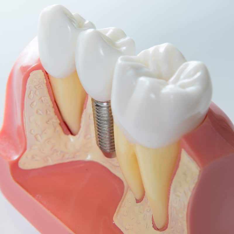 dental implant palm desert