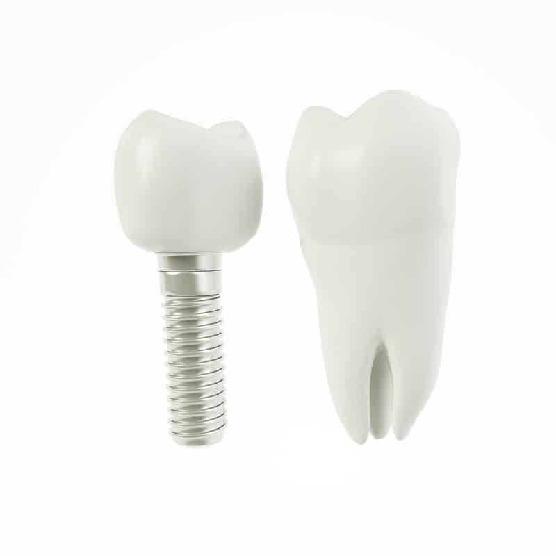 dental implants palm desert